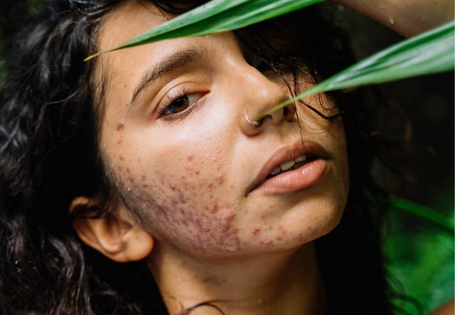 Sivilce ve Akne Tedavisi 101: Pürüzsüz Cilt Bir Hayal Değil